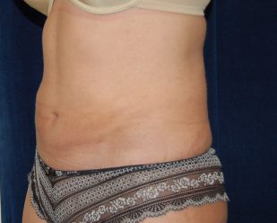 Liposuction before and after - after