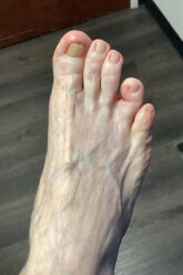 Foot Treatment before and after - after
