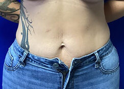 Liposuction before and after - after