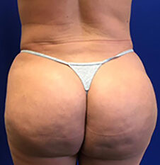 Cellulite Treatment before and after - after