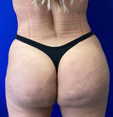 Cellulite Treatment before and after - after
