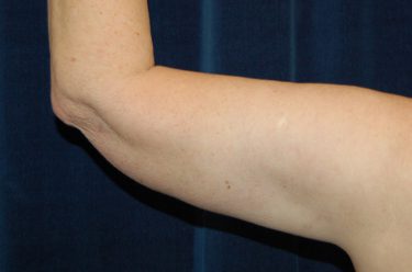 Arm Lift before and after - after