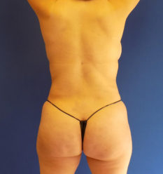 Fat Transfer before and after - after