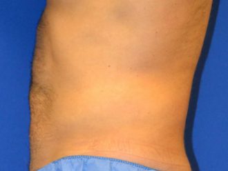 Liposuction before and after - after