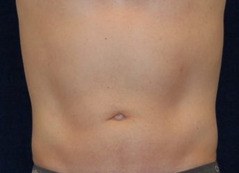 Liposuction before and after - after