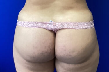 Fat Transfer before and after - after