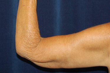 Arm Lift before and after - after
