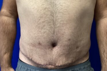 Male Abdominoplasty before and after - after