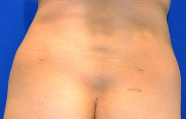 Liposuction before and after - after