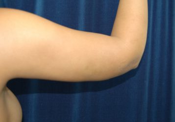 Liposuction before and after - after