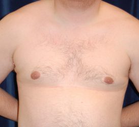 Liposuction before and after - after