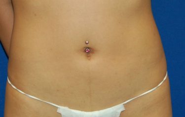 Fat Transfer before and after - after