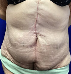 Liposuction before and after - after