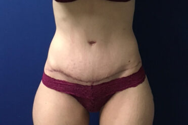 Abdominoplasty before and after - after