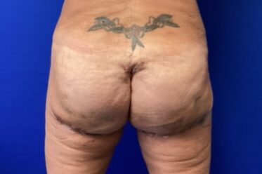 Gluteal Implants before and after - after