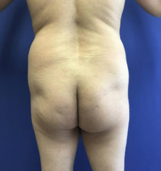 Fat Transfer before and after - before