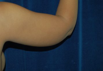 Liposuction before and after - before