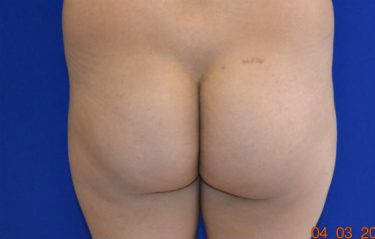 Fat Transfer before and after - before