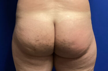 Fat Transfer before and after - before