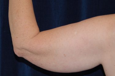 Arm Lift before and after - before