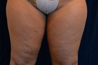 Liposuction before and after - before