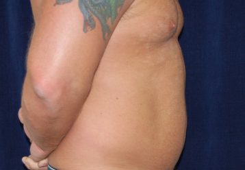Liposuction before and after - before