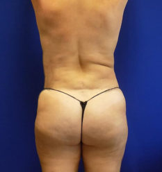 Fat Transfer before and after - before
