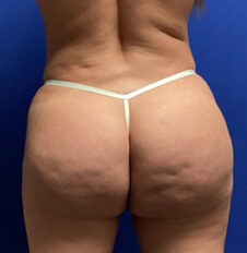 Cellulite Treatment before and after - before