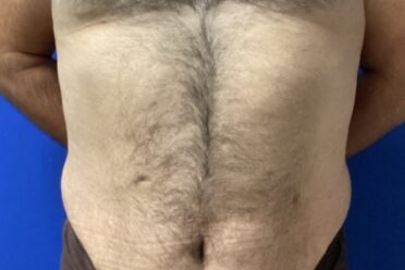 Male Abdominoplasty before and after - before