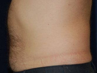 Liposuction before and after - before