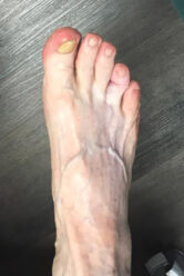 Foot Treatment before and after - before