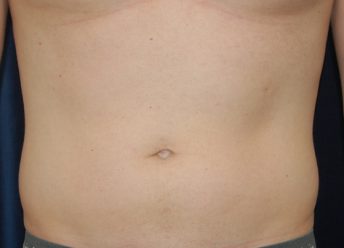 Liposuction before and after - before