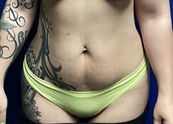 Liposuction before and after - before