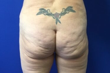 Gluteal Implants before and after - before