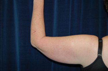 Liposuction before and after - before