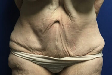 Abdominoplasty before and after - before