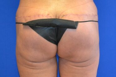 Gluteal Implants before and after - before