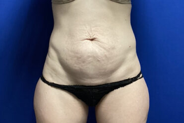 Abdominoplasty before and after - before