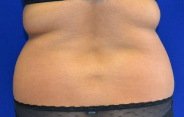 Liposuction before and after - before