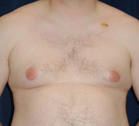 Liposuction before and after - before