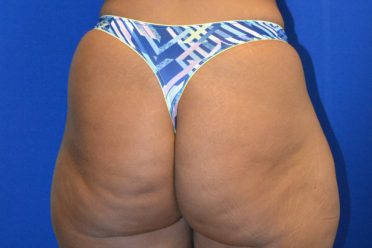 Fat Transfer before and after - before
