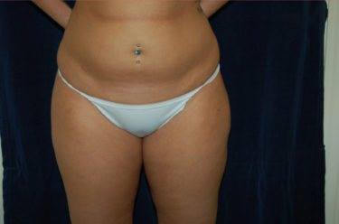 Liposuction before and after - before