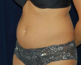 Liposuction before and after - before