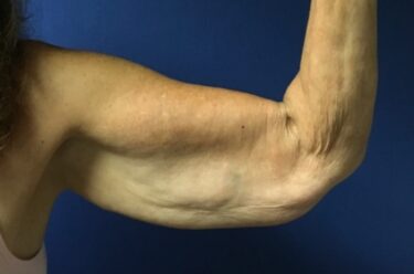 Arm Lift before and after - before