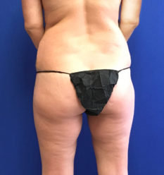 Fat Transfer before and after - before