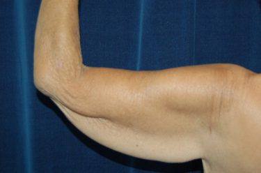 Arm Lift before and after - before