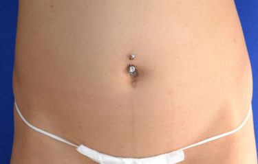 Fat Transfer before and after - before