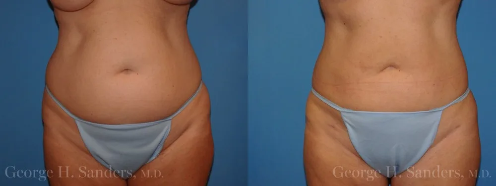 Liposuction before and after - after