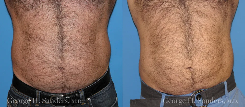 Liposuction before and after - after