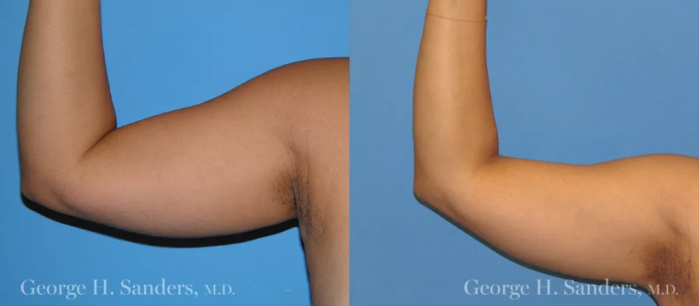 Liposuction before and after - before